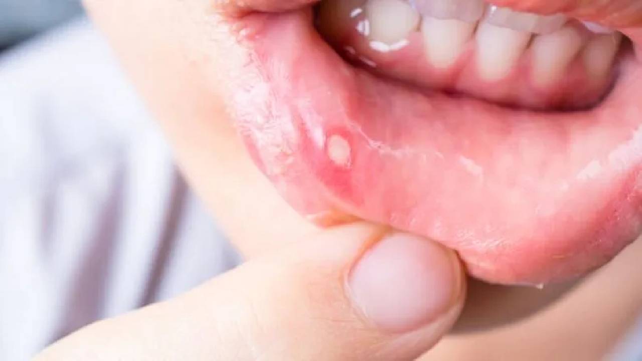 Sore lips that won't heal quickly could be early signs of lip cancer