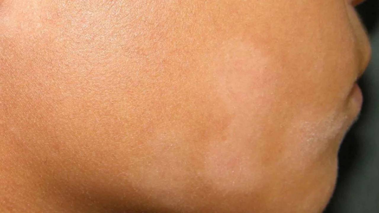 white-spots-on-skin-possible-causes-and-treatments-white-spot-on