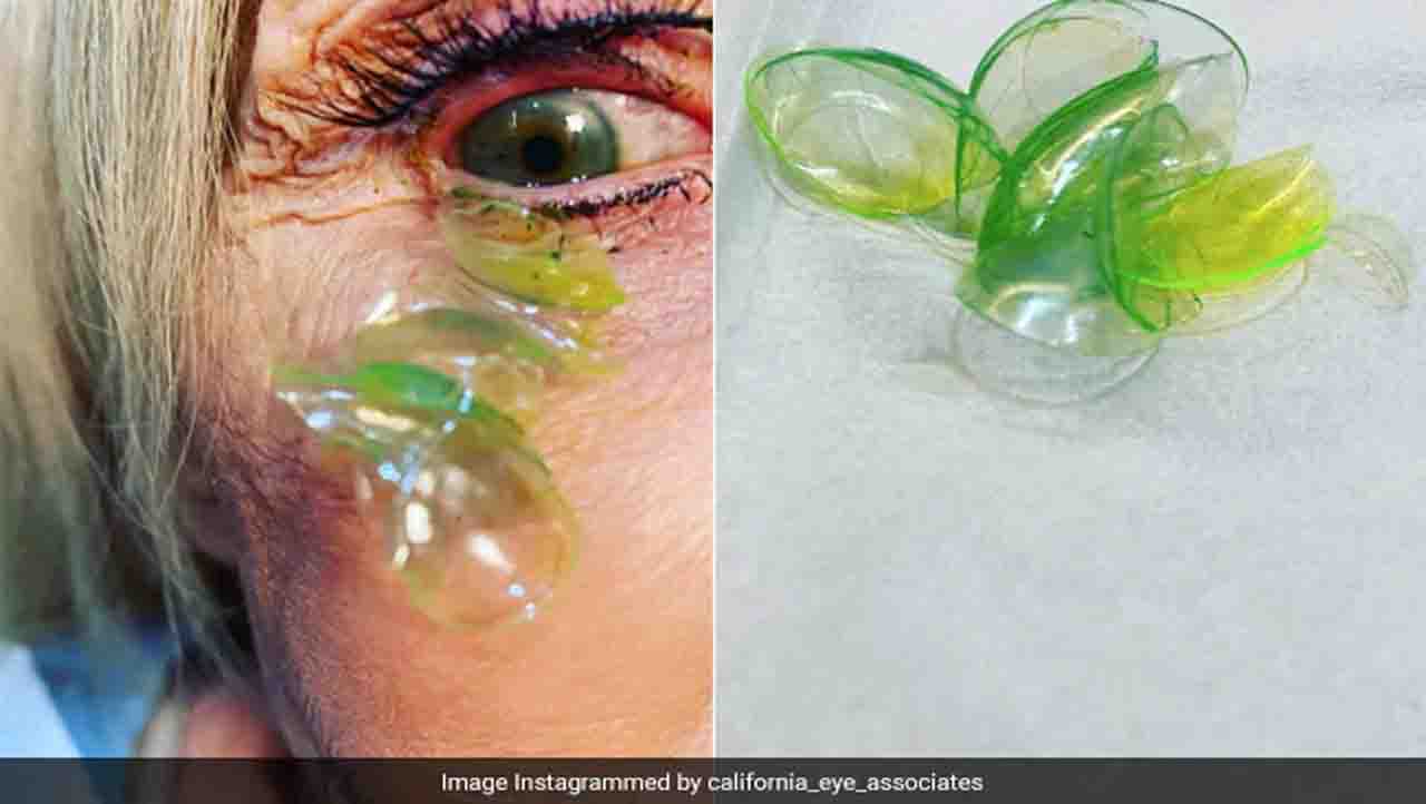 Shocking Video Shows Doctor Removing 23 Contact Lenses From Patients