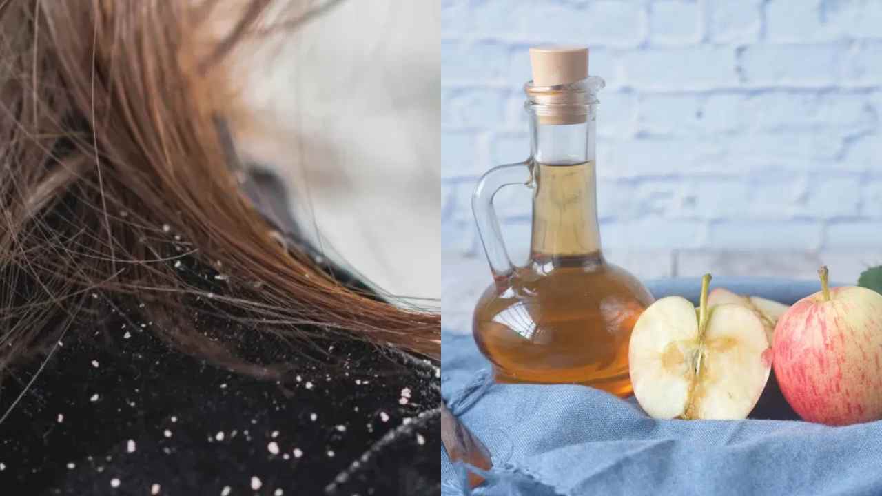 Dandruff Suffering from Dandruff in Winter? Try apple cider vinegar