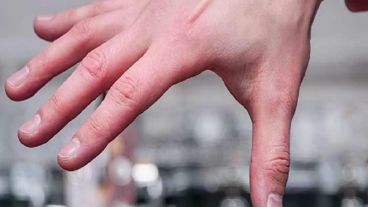 Fingers Swelling in Winter Fingers are getting stiff or turning red in